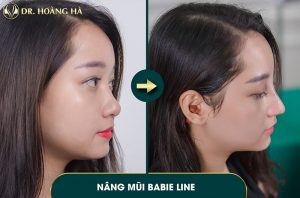 khach-hang-sau-khi-nang-mui-tai-dr-hoang-ha
