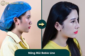 khach-hang-sau-khi-nang-mui-tai-dr-hoang-ha