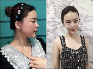 Nâng mũi và cấy mỡ tự thân