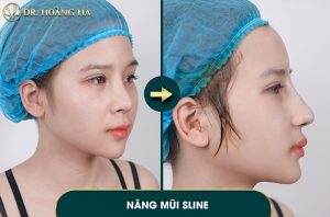 khach-hang-sau-khi-nang-mui-tai-dr-hoang-ha