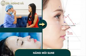 Nâng mũi giữ được bao lâu