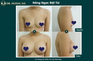 khach-hang-sau-khi-nang-nguc