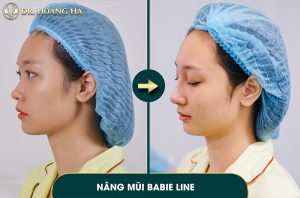 khach-hang-sau-khi-nang-mui-tai-dr-hoang-ha