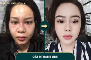 Cắt mí to quá có sửa được không