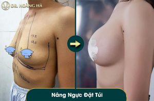 KH Nâng Ngực Dr Hoàng Hà