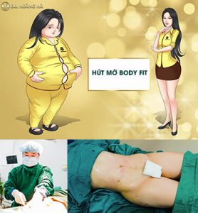 Hút mỡ Body Fit
