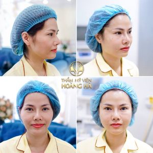 cấy mỡ hốc mắt sâu duy trì được bao lâu