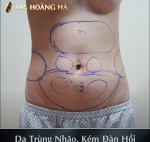 anh-do-ve-hut-mo-bung