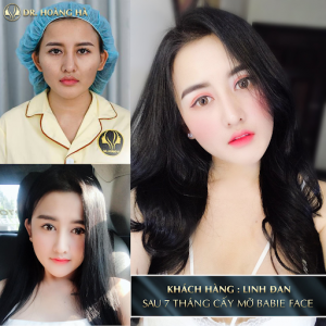 Cấy mỡ mặt bao lâu thì đẹp