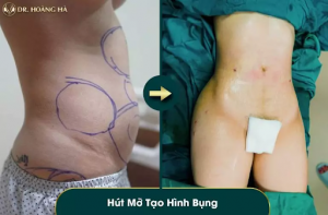 hinh-anh-hut-mo-bung