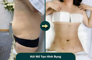 hinh-anh-hut-mo-bung